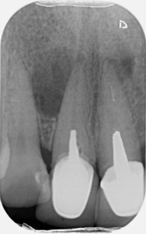 Post removal and endodontic retreatment case